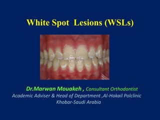 White Spot Lesions (WSLs)
Dr.Marwan Mouakeh , Consultant Orthodontist
Academic Adviser & Head of Department ,Al-Hokail Polclinic
Khobar-Saudi Arabia
 