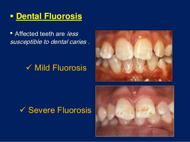 White spot lesions
