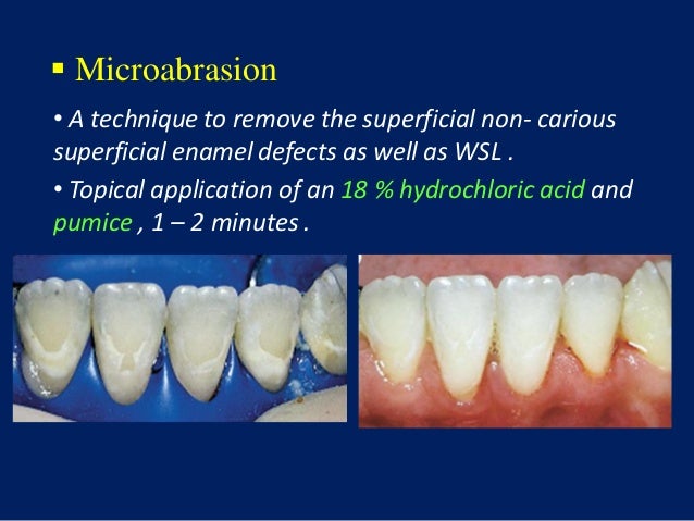 White spot lesions