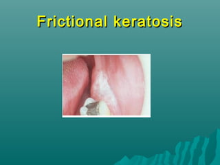 Frictional keratosis

 