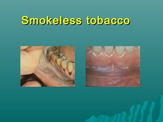 Smokeless tobacco

 