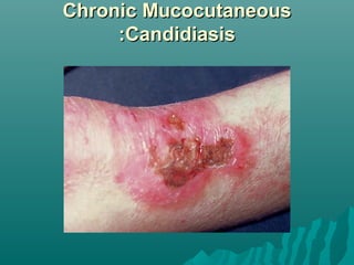 Chronic Mucocutaneous
:Candidiasis

 