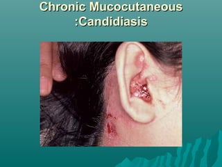 Chronic Mucocutaneous
:Candidiasis

 