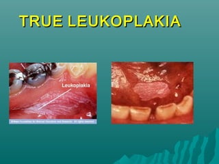 TRUE LEUKOPLAKIA

 