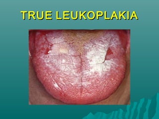 TRUE LEUKOPLAKIA

 
