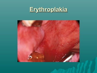Erythroplakia

 