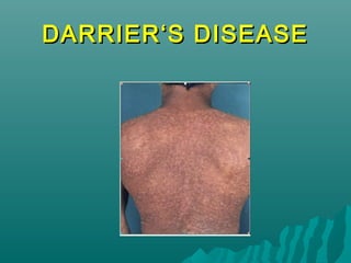 DARRIER‘S DISEASE

 