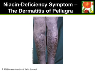© 2016 Cengage Learning. All Rights Reserved.
Niacin-Deficiency Symptom –
The Dermatitis of Pellagra
 