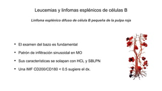 Leucemias y linfomas esplénicos de células B
• El examen del bazo es fundamental
• Patrón de infiltración sinusoidal en MO
• Sus características se solapan con HCL y SBLPN
• Una IMF CD200/CD180 < 0.5 sugiere el dx.
Linfoma esplénico difuso de célula B pequeña de la pulpa roja
 