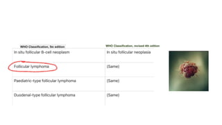Linfoma folicular (LF)
WHO Classification, revised 4th edition
WHO Classification, 5th edition
 