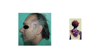 Linfoma cutàneo primario de celulas b centrofoliculares
 