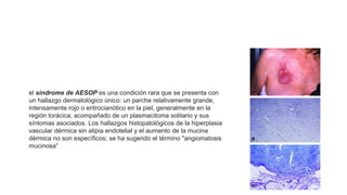 el síndrome de AESOP es una condición rara que se presenta con
un hallazgo dermatológico único: un parche relativamente grande,
intensamente rojo o eritrocianótico en la piel, generalmente en la
región torácica, acompañado de un plasmacitoma solitario y sus
síntomas asociados. Los hallazgos histopatológicos de la hiperplasia
vascular dérmica sin atipia endotelial y el aumento de la mucina
dérmica no son específicos; se ha sugerido el término "angiomatosis
mucinosa”
Neoplasias de células plasmáticas y otras enfermedades con
paraproteínas: nuevas condiciones de AESOP a TEMPI
 