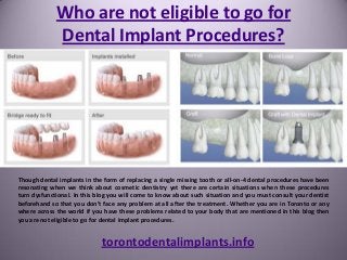 Who are not eligible to go for
Dental Implant Procedures?
torontodentalimplants.info
Though dental implants in the form of replacing a single missing tooth or all-on-4 dental procedures have been
resonating when we think about cosmetic dentistry yet there are certain situations when these procedures
turn dysfunctional. In this blog you will come to know about such situation and you must consult your dentist
beforehand so that you don’t face any problem at all after the treatment. Whether you are in Toronto or any
where across the world if you have these problems related to your body that are mentioned in this blog then
you are not eligible to go for dental implant procedures.
 