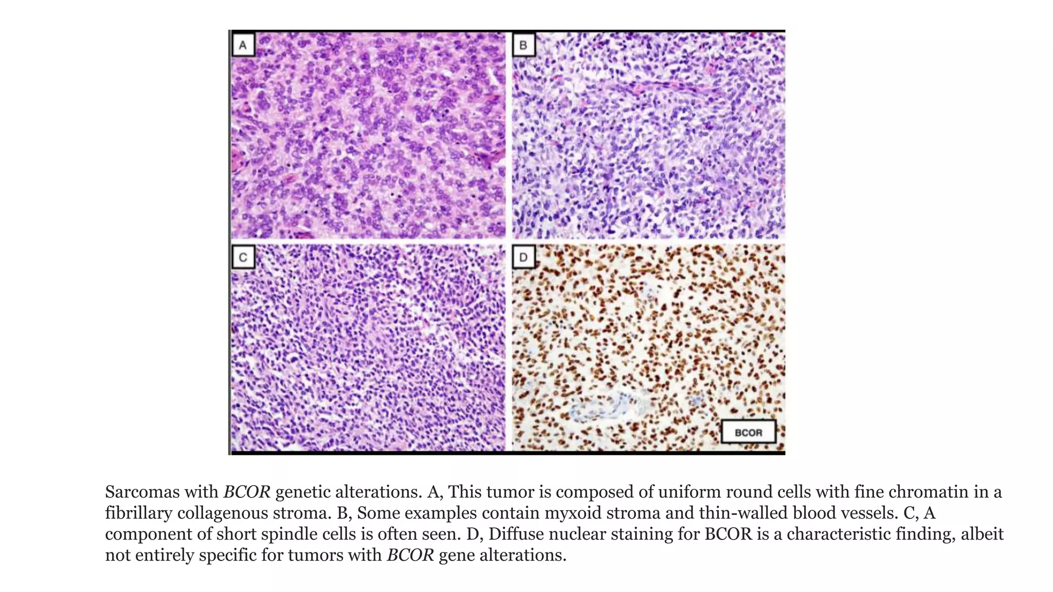 Sarcoma Example WHO Bone and soft tissue tumor UPDATE 2020 | PPTX