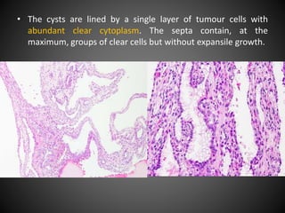 • The cysts are lined by a single layer of tumour cells with
abundant clear cytoplasm. The septa contain, at the
maximum, groups of clear cells but without expansile growth.
 