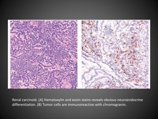 Renal carcinoid. (A) Hematoxylin and eosin stains reveals obvious neuroendocrine
differentiation. (B) Tumor cells are immunoreactive with chromogranin.
 