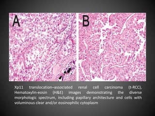 Xp11 translocation–associated renal cell carcinoma (t-RCC),
Hematoxylin-eosin (H&E) images demonstrating the diverse
morphologic spectrum, including papillary architecture and cells with
voluminous clear and/or eosinophilic cytoplasm
 