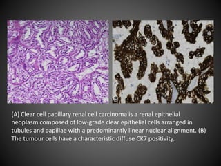 (A) Clear cell papillary renal cell carcinoma is a renal epithelial
neoplasm composed of low-grade clear epithelial cells arranged in
tubules and papillae with a predominantly linear nuclear alignment. (B)
The tumour cells have a characteristic diffuse CK7 positivity.
 