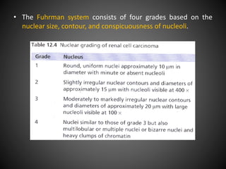 • The Fuhrman system consists of four grades based on the
nuclear size, contour, and conspicuousness of nucleoli.
 
