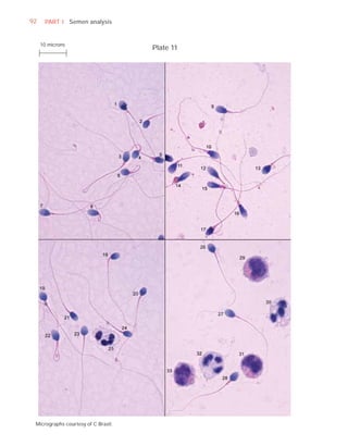 92    PART I Semen analysis


     10 microns
                                     Plate 11




 Micrographs courtesy of C Brazil.
 