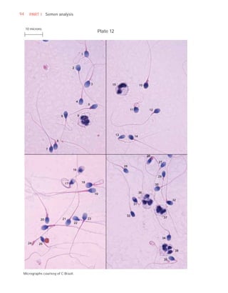 94     PART I Semen analysis


     10 microns
                                     Plate 12




 Micrographs courtesy of C Brazil.
 