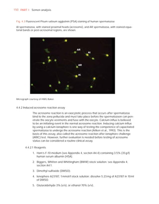 150 PART I Semen analysis



 Fig. 4.3 Fluorescent Pisum sativum agglutinin (PSA) staining of human spermatozoa

 AI spermatozoa, with stained proximal heads (acrosome), and AR spermatozoa, with stained equa-
 torial bands or post-acrosomal regions, are shown.




 Micrograph courtesy of HWG Baker.


 4.4.2 Induced acrosome reaction assay

               The acrosome reaction is an exocytotic process that occurs after spermatozoa
               bind to the zona pellucida and must take place before the spermatozoon can pen-
               etrate the oocyte vestments and fuse with the oocyte. Calcium inﬂux is believed
               to be an initiating event in the normal acrosome reaction. Inducing calcium inﬂux
               by using a calcium ionophore is one way of testing the competence of capacitated
               spermatozoa to undergo the acrosome reaction (Aitken et al., 1993). This is the
               basis of this assay, also called the acrosome reaction after ionophore challenge
               (ARIC) test. However, further evaluation is needed before testing of acrosome
               status can be considered a routine clinical assay.

        4.4.2.1 Reagents

               1. Ham’s F-10 medium (see Appendix 4, section A4.4) containing 3.5% (35 g/l)
                  human serum albumin (HSA).

               2. Biggers, Whitten and Whittingham (BWW) stock solution: see Appendix 4,
                  section A4.1.

               3. Dimethyl sulfoxide (DMSO).

               4. Ionophore A23187, 1 mmol/l stock solution: dissolve 5.23 mg of A23187 in 10 ml
                  of DMSO.

               5. Glutaraldehyde 3% (v/v), or ethanol 70% (v/v).
 