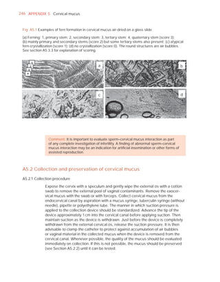 246 APPENDIX 5 Cervical mucus



 Fig. A5.1 Examples of fern formation in cervical mucus air-dried on a glass slide

 (a) Ferning: 1, primary stem; 2, secondary stem; 3, tertiary stem; 4, quaternary stem (score 3);
 (b) mainly primary and secondary stems (score 2) but some tertiary stems also present; (c) atypical
 fern crystallization (score 1); (d) no crystallization (score 0). The round structures are air bubbles.
 See section A5.3.3 for explanation of scoring.



                                                 a                                                     b




                                                 c                                                     d




                 Comment: It is important to evaluate sperm–cervical mucus interaction as part
                 of any complete investigation of infertility. A ﬁnding of abnormal sperm–cervical
                 mucus interaction may be an indication for artiﬁcial insemination or other forms of
                 assisted reproduction.



 A5.2 Collection and preservation of cervical mucus
 A5.2.1 Collection procedure

               Expose the cervix with a speculum and gently wipe the external os with a cotton
               swab to remove the external pool of vaginal contaminants. Remove the exocer-
               vical mucus with the swab or with forceps. Collect cervical mucus from the
               endocervical canal by aspiration with a mucus syringe, tuberculin syringe (without
               needle), pipette or polyethylene tube. The manner in which suction pressure is
               applied to the collection device should be standardized. Advance the tip of the
               device approximately 1 cm into the cervical canal before applying suction. Then
               maintain suction as the device is withdrawn. Just before the device is completely
               withdrawn from the external cervical os, release the suction pressure. It is then
               advisable to clamp the catheter to protect against accumulation of air bubbles
               or vaginal material in the collected mucus when the device is removed from the
               cervical canal. Whenever possible, the quality of the mucus should be evaluated
               immediately on collection. If this is not possible, the mucus should be preserved
               (see Section A5.2.2) until it can be tested.
 