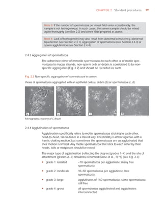 CHAPTER 2 Standard procedures              19




                 Note 3: If the number of spermatozoa per visual ﬁeld varies considerably, the
                 sample is not homogeneous. In such cases, the semen sample should be mixed
                 again thoroughly (see Box 2.3) and a new slide prepared as above.

                 Note 4: Lack of homogeneity may also result from abnormal consistency, abnormal
                 liquefaction (see Section 2.3.1), aggregation of spermatozoa (see Section 2.4.3) or
                 sperm agglutination (see Section 2.4.4).


2.4.3 Aggregation of spermatozoa

               The adherence either of immotile spermatozoa to each other or of motile sper-
               matozoa to mucus strands, non-sperm cells or debris is considered to be non-
               speciﬁc aggregation (Fig. 2.2) and should be recorded as such.


Fig. 2.2 Non-speciﬁc aggregation of spermatozoa in semen

Views of spermatozoa aggregated with an epithelial cell (a), debris (b) or spermatozoa (c, d).




 a                           b                         c                          d

Micrographs courtesy of C Brazil.


2.4.4 Agglutination of spermatozoa

               Agglutination speciﬁcally refers to motile spermatozoa sticking to each other,
               head-to-head, tail-to-tail or in a mixed way. The motility is often vigorous with a
               frantic shaking motion, but sometimes the spermatozoa are so agglutinated that
               their motion is limited. Any motile spermatozoa that stick to each other by their
               heads, tails or midpieces should be noted.

               The major type of agglutination (reﬂecting the degree (grades 1–4) and the site of
               attachment (grades A–E) should be recorded (Rose et al., 1976) (see Fig. 2.3):
               y grade 1: isolated           <10 spermatozoa per agglutinate, many free
                                             spermatozoa
               y grade 2: moderate           10–50 spermatozoa per agglutinate, free
                                             spermatozoa
               y grade 3: large              agglutinates of >50 spermatozoa, some spermatozoa
                                             still free
               y grade 4: gross              all spermatozoa agglutinated and agglutinates
                                             interconnected
 