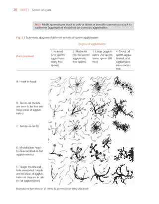 20   PART I Semen analysis




                   Note: Motile spermatozoa stuck to cells or debris or immotile spermatozoa stuck to
                   each other (aggregation) should not be scored as agglutination.


 Fig. 2.3 Schematic diagram of different extents of sperm agglutination

                                                           Degree of agglutination

                                 1. Isolated         2. Moderate        3. Large (aggluti-   4. Gross (all
 Parts involved                  (<10 sperm/         (10–50 sperm/      nates >50 sperm,     sperm agglu-
                                 agglutinate,        agglutinate,       some sperm still     tinated, and
                                 many free           free sperm)        free)                agglutinates
                                 sperm)                                                      interconnec-
                                                                                             ted)



 A. Head-to-head




 B. Tail-to-tail (heads
 are seen to be free and
 move clear of aggluti-
 nates)



 C. Tail-tip-to-tail-tip




 D. Mixed (clear head-
 to-head and tail-to-tail
 agglutinations)



 E. Tangle (heads and
 tails enmeshed. Heads
 are not clear of aggluti-
 nates as they are in tail-
 to-tail agglutination)


 Reproduced from Rose et al. (1976) by permission of Wiley-Blackwell.
 
