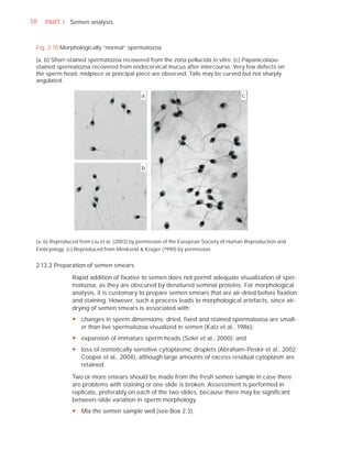 58   PART I Semen analysis



 Fig. 2.10 Morphologically “normal” spermatozoa

 (a, b) Shorr-stained spermatozoa recovered from the zona pellucida in vitro. (c) Papanicolaou-
 stained spermatozoa recovered from endocervical mucus after intercourse. Very few defects on
 the sperm head, midpiece or principal piece are observed. Tails may be curved but not sharply
 angulated.

                                            a                                         c




                                            b




 (a, b) Reproduced from Liu et al. (2003) by permission of the European Society of Human Reproduction and
 Embryology. (c) Reproduced from Menkveld & Kruger (1990) by permission.


 2.13.2 Preparation of semen smears

                Rapid addition of ﬁxative to semen does not permit adequate visualization of sper-
                matozoa, as they are obscured by denatured seminal proteins. For morphological
                analysis, it is customary to prepare semen smears that are air-dried before ﬁxation
                and staining. However, such a process leads to morphological artefacts, since air-
                drying of semen smears is associated with:
                y changes in sperm dimensions: dried, fixed and stained spermatozoa are small-
                  er than live spermatozoa visualized in semen (Katz et al., 1986);
                y expansion of immature sperm heads (Soler et al., 2000); and
                y loss of osmotically sensitive cytoplasmic droplets (Abraham-Peskir et al., 2002;
                  Cooper et al., 2004), although large amounts of excess residual cytoplasm are
                  retained.

                Two or more smears should be made from the fresh semen sample in case there
                are problems with staining or one slide is broken. Assessment is performed in
                replicate, preferably on each of the two slides, because there may be signiﬁcant
                between-slide variation in sperm morphology.
                y Mix the semen sample well (see Box 2.3).
 