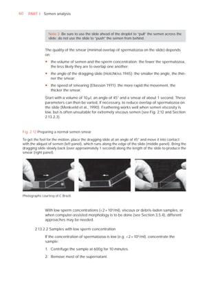 60   PART I Semen analysis




                  Note 3: Be sure to use the slide ahead of the droplet to “pull” the semen across the
                  slide; do not use the slide to “push” the semen from behind.


                The quality of the smear (minimal overlap of spermatozoa on the slide) depends
                on:
                y the volume of semen and the sperm concentration: the fewer the spermatozoa,
                  the less likely they are to overlap one another;
                y the angle of the dragging slide (Hotchkiss 1945): the smaller the angle, the thin-
                  ner the smear;
                y the speed of smearing (Eliasson 1971): the more rapid the movement, the
                  thicker the smear.

                Start with a volume of 10 Pl, an angle of 45° and a smear of about 1 second. These
                parameters can then be varied, if necessary, to reduce overlap of spermatozoa on
                the slide (Menkveld et al., 1990). Feathering works well when semen viscosity is
                low, but is often unsuitable for extremely viscous semen (see Fig. 2.12 and Section
                2.13.2.3).


 Fig. 2.12 Preparing a normal semen smear

 To get the feel for the motion, place the dragging slide at an angle of 45° and move it into contact
 with the aliquot of semen (left panel), which runs along the edge of the slide (middle panel). Bring the
 dragging slide slowly back (over approximately 1 second) along the length of the slide to produce the
 smear (right panel).




 Photographs courtesy of C Brazil.



                With low sperm concentrations (<2 × 106 /ml), viscous or debris-laden samples, or
                when computer-assisted morphology is to be done (see Section 3.5.4), different
                approaches may be needed.

         2.13.2.2 Samples with low sperm concentration

                If the concentration of spermatozoa is low (e.g. <2 × 106 /ml), concentrate the
                sample:

                1. Centrifuge the sample at 600g for 10 minutes.

                2. Remove most of the supernatant.
 