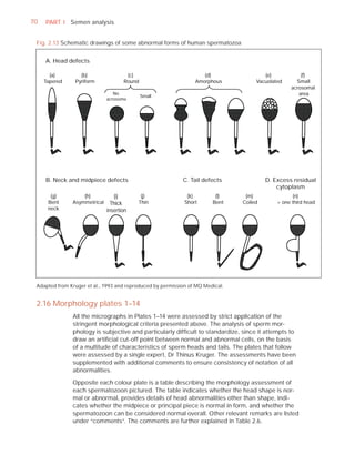 70   PART I Semen analysis


 Fig. 2.13 Schematic drawings of some abnormal forms of human spermatozoa


     A. Head defects

       (a)        (b)                 (c)                           (d)                 (e)           (f)
     Tapered    Pyriform             Round                       Amorphous           Vacuolated     Small
                                                                                                  acrosomal
                                 No
                                             Small                                                   area
                              acrosome




     B. Neck and midpiece defects                           C. Tail defects              D. Excess residual
                                                                                             cytoplasm
       (g)         (h)           (i)       (j)                (k)        (l)     (m)                (n)
      Bent     Asymmetrical     Thick     Thin               Short      Bent    Coiled       > one third head
      neck                    insertion




 Adapted from Kruger et al., 1993 and reproduced by permission of MQ Medical.


 2.16 Morphology plates 1–14
               All the micrographs in Plates 1–14 were assessed by strict application of the
               stringent morphological criteria presented above. The analysis of sperm mor-
               phology is subjective and particularly difﬁcult to standardize, since it attempts to
               draw an artiﬁcial cut-off point between normal and abnormal cells, on the basis
               of a multitude of characteristics of sperm heads and tails. The plates that follow
               were assessed by a single expert, Dr Thinus Kruger. The assessments have been
               supplemented with additional comments to ensure consistency of notation of all
               abnormalities.

               Opposite each colour plate is a table describing the morphology assessment of
               each spermatozoon pictured. The table indicates whether the head shape is nor-
               mal or abnormal, provides details of head abnormalities other than shape, indi-
               cates whether the midpiece or principal piece is normal in form, and whether the
               spermatozoon can be considered normal overall. Other relevant remarks are listed
               under “comments”. The comments are further explained in Table 2.6.
 