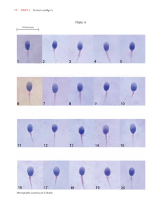 78   PART I Semen analysis



                                     Plate 4
     10 microns




 Micrographs courtesy of C Brazil.
 