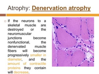 Atrophy: Denervation atrophyIf the neurons to a skeletal muscle are destroyed or the neuromuscular junctions become nonfunctional, the denervated muscle fibers will become progressively smaller in diameter, and the amount of contractile proteins they contain will decrease. 