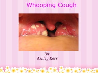 Whooping Cough
By:
Ashley Kerr
 