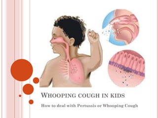WHOOPING COUGH IN KIDS
How to deal with Pertussis or Whooping Cough
 