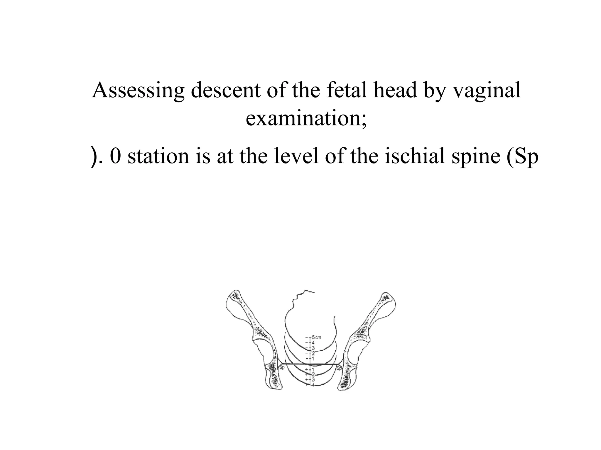 Assessing descent of the fetal head by vaginal
examination;
0 station is at the level of the ischial spine (Sp(.
 