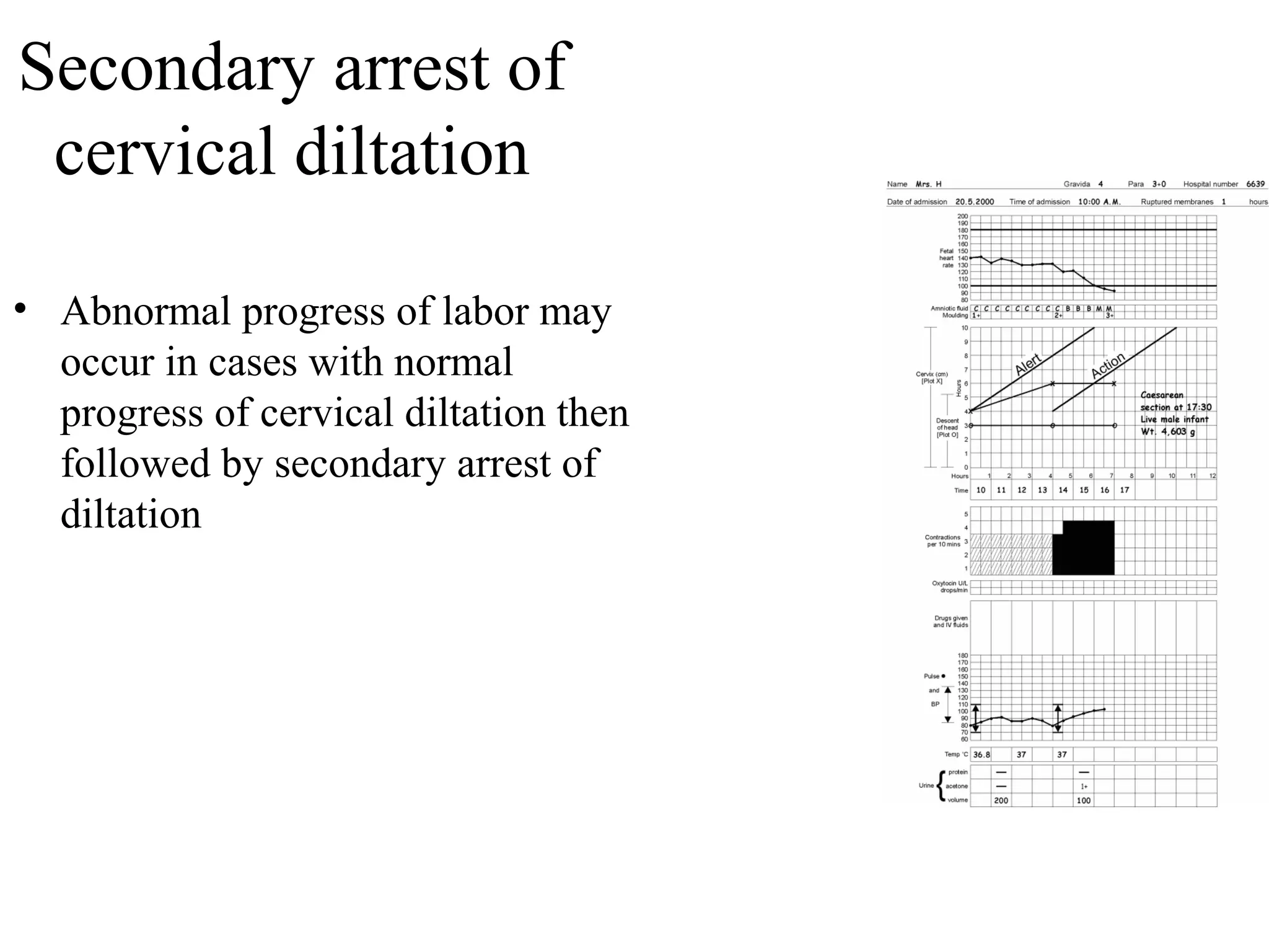 Secondary arrest of
cervical diltation
• Abnormal progress of labor may
occur in cases with normal
progress of cervical diltation then
followed by secondary arrest of
diltation
 