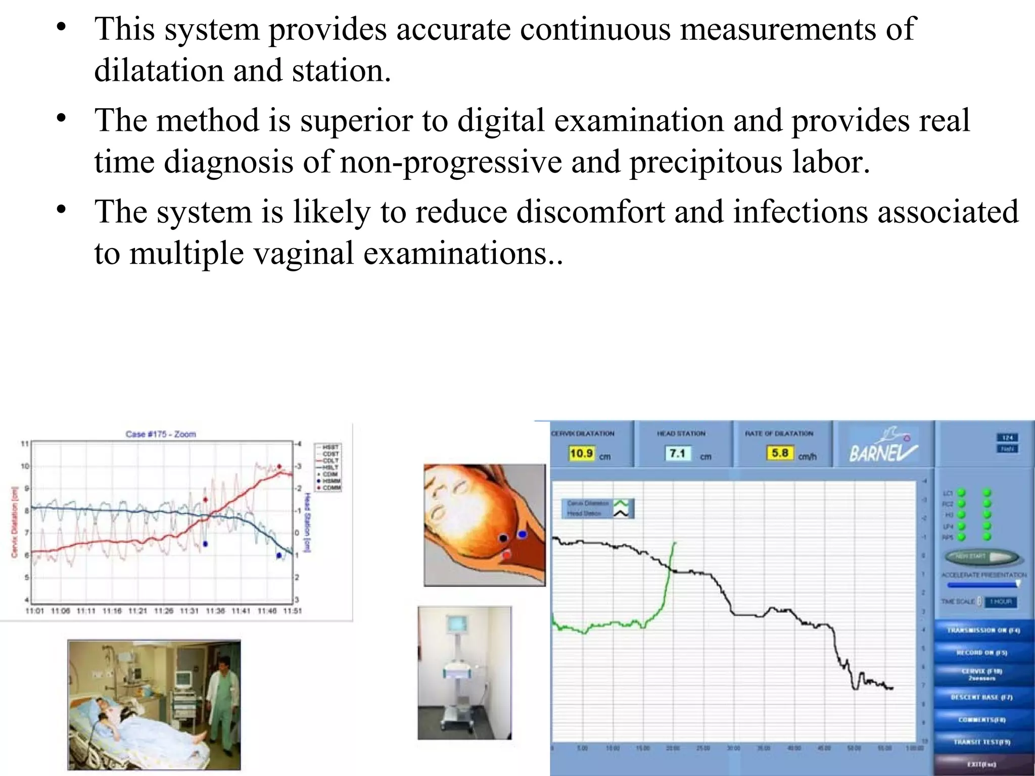 • This system provides accurate continuous measurements of
dilatation and station.
• The method is superior to digital examination and provides real
time diagnosis of non-progressive and precipitous labor.
• The system is likely to reduce discomfort and infections associated
to multiple vaginal examinations..
 