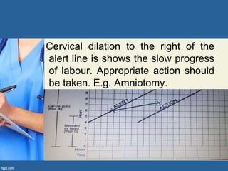 Cervical dilation to the right of the
alert line is shows the slow progress
of labour. Appropriate action should
be taken. E.g. Amniotomy.
 
