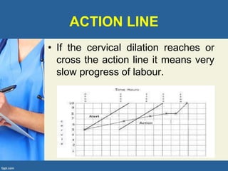 ACTION LINE
• If the cervical dilation reaches or
cross the action line it means very
slow progress of labour.
 