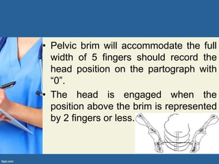 • Pelvic brim will accommodate the full
width of 5 fingers should record the
head position on the partograph with
“0”.
• The head is engaged when the
position above the brim is represented
by 2 fingers or less.
 