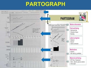 PARTOGRAPH
 