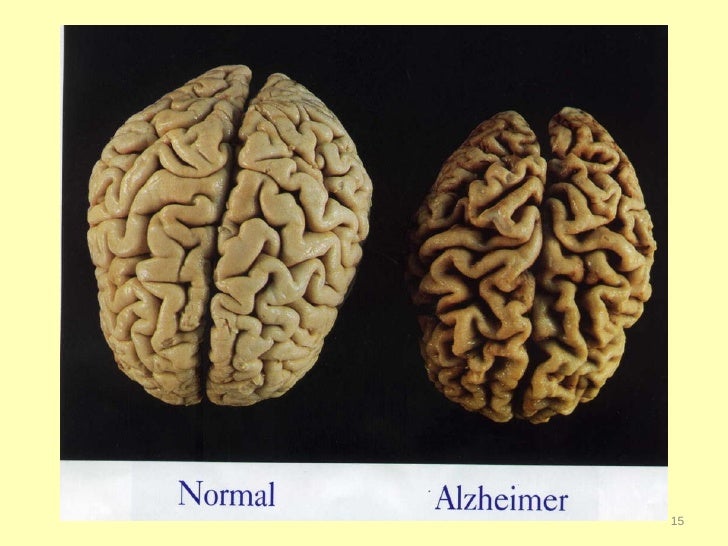 Teepa Snow, Dementia Expert, on understanding Alzheimers patient beha…