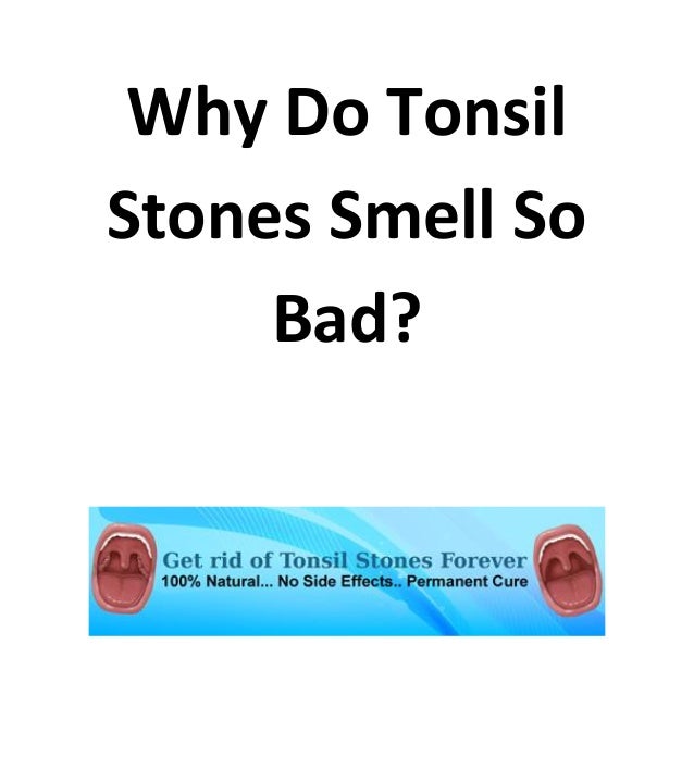 Why do tonsil stones smell so bad