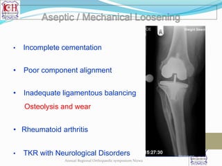 • Incomplete cementation
• Poor component alignment
• Inadequate ligamentous balancing
Osteolysis and wear
• Rheumatoid arthritis
• TKR with Neurological Disorders
Annual Regional Orthopaedic symposium Nizwa
 