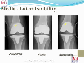 44
Varusstress ValgusstressNeutral
Medio - Lateral stability
Annual Regional Orthopaedic symposium Nizwa
 