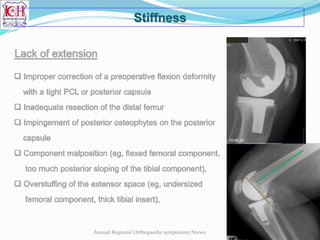 Stiffness
Annual Regional Orthopaedic symposium Nizwa
 