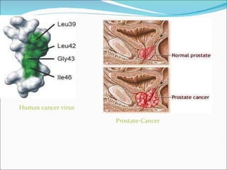 Human cancer virus Prostate-Cancer 