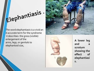 A lower leg
and a
scrotum
showing the
effect of
elephantiasi
s.
The word elephantiasis is a vivid an
d accurate term for the syndrome
it describes: the gross (visible)
enlargement of the
arms, legs, or genitals to
elephantoid size.
 